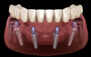 Интересные преимущества имплантации зубов методом All-on-4
