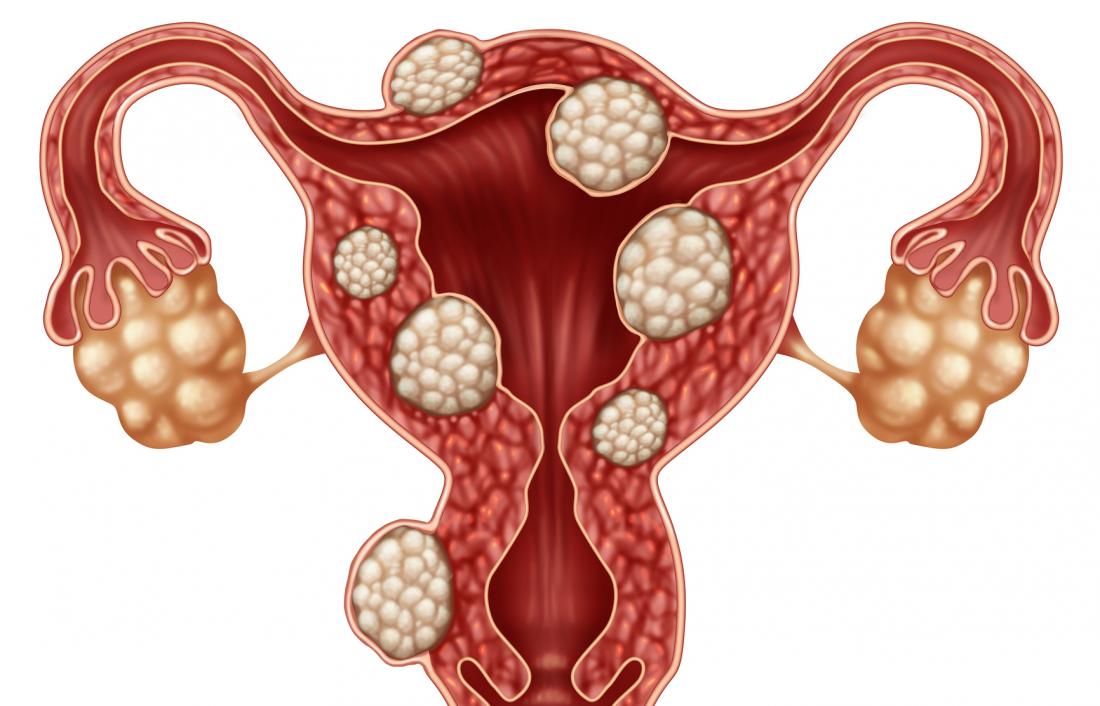 Фіброміома матки: Поняття, Симптоми та Лікування в Yuzko Medical Center