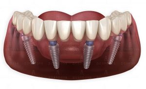 Плюсы имплантации зубов All-on-4
