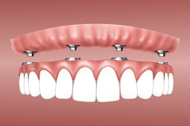 Инновационные подходы в имплантации зубов